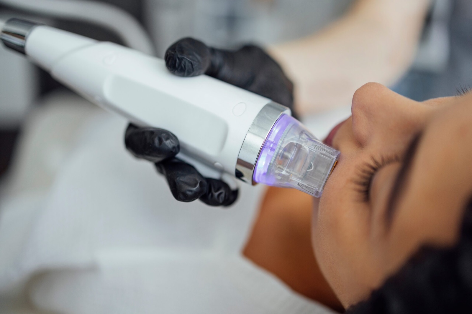 Radiofrequenz-Microneedling Behandlung
